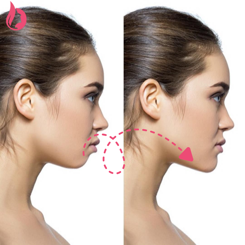 Chin Botox Before And After​