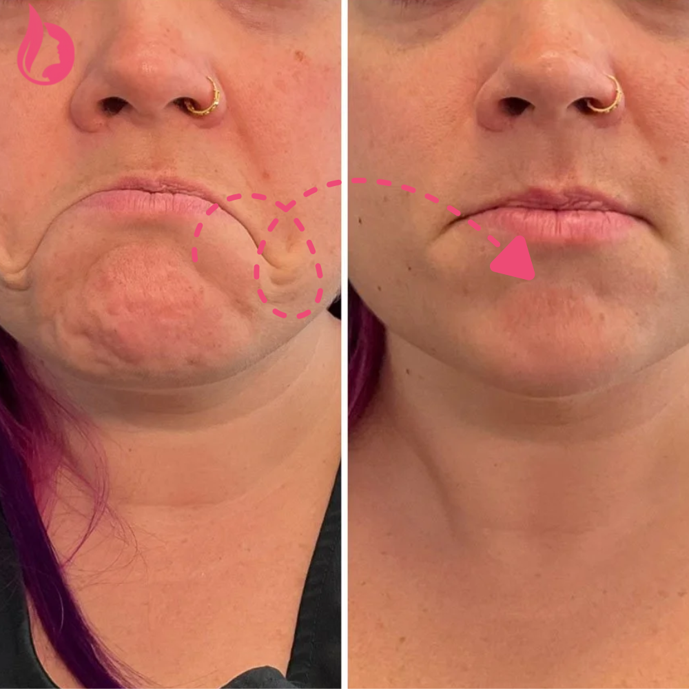 Chin Botox Before And After