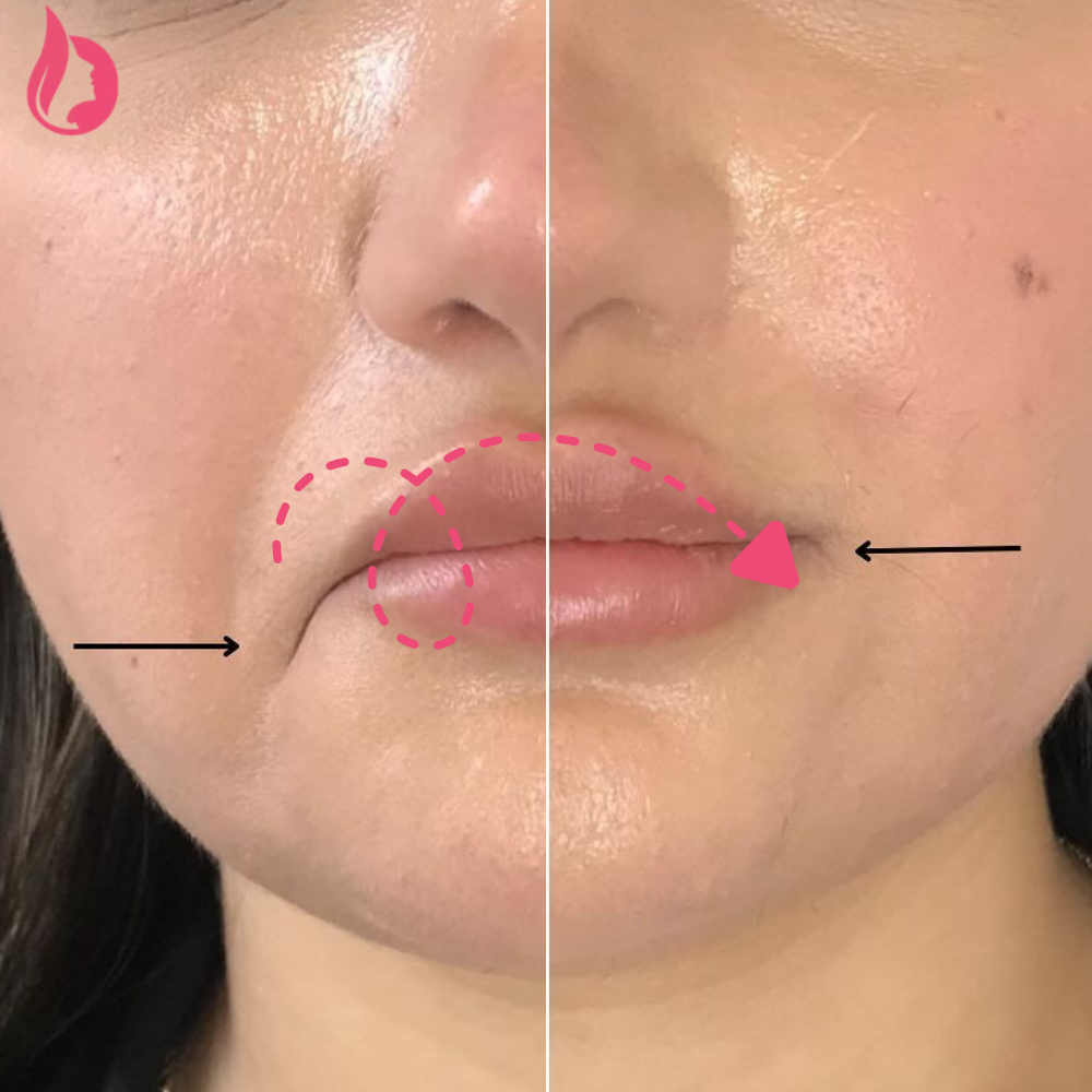 Chin Botox Before And After​
