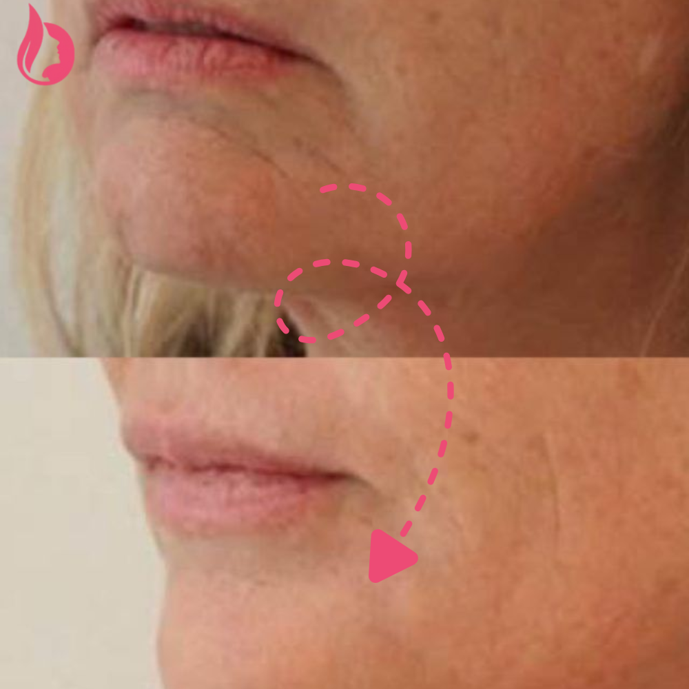 Chin Botox Before And After​