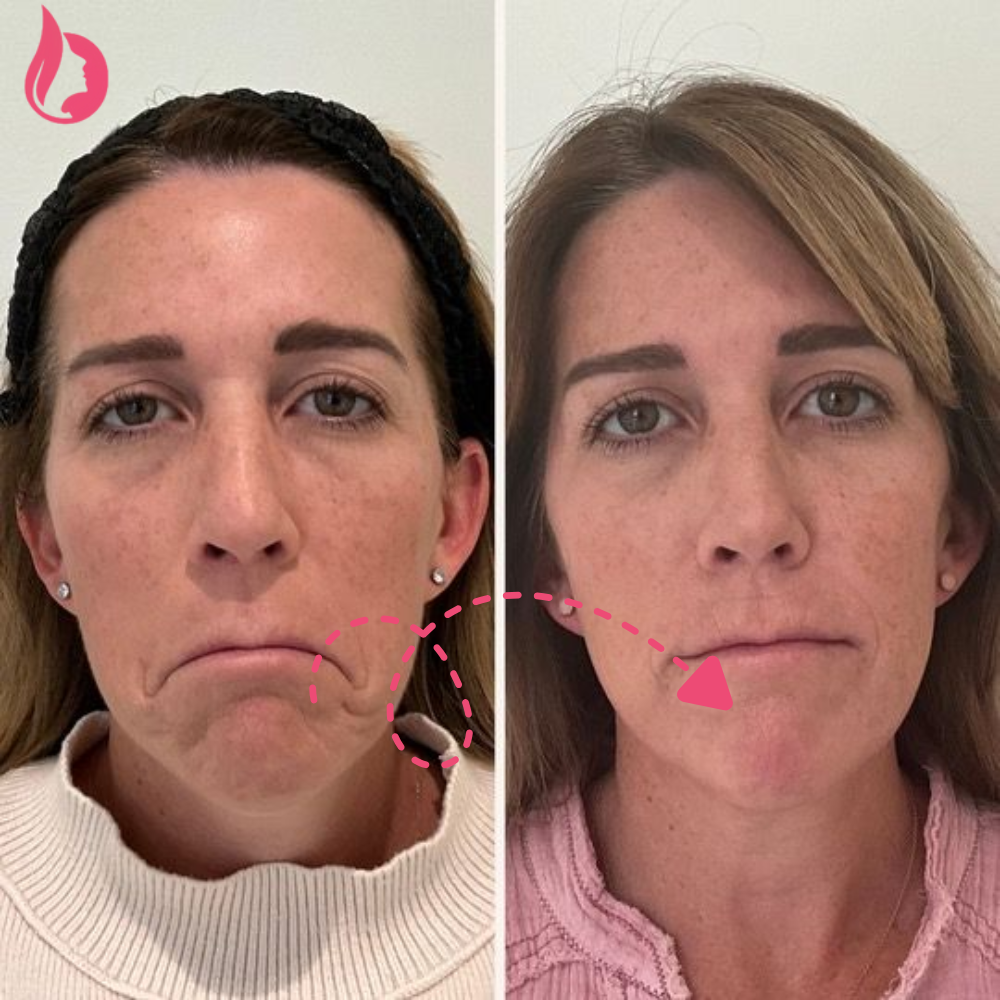 chin botox before and after​
