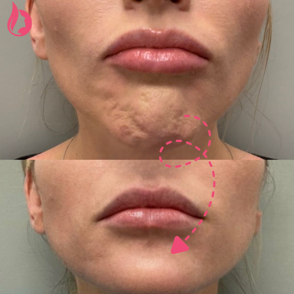 Chin Botox Before And After​