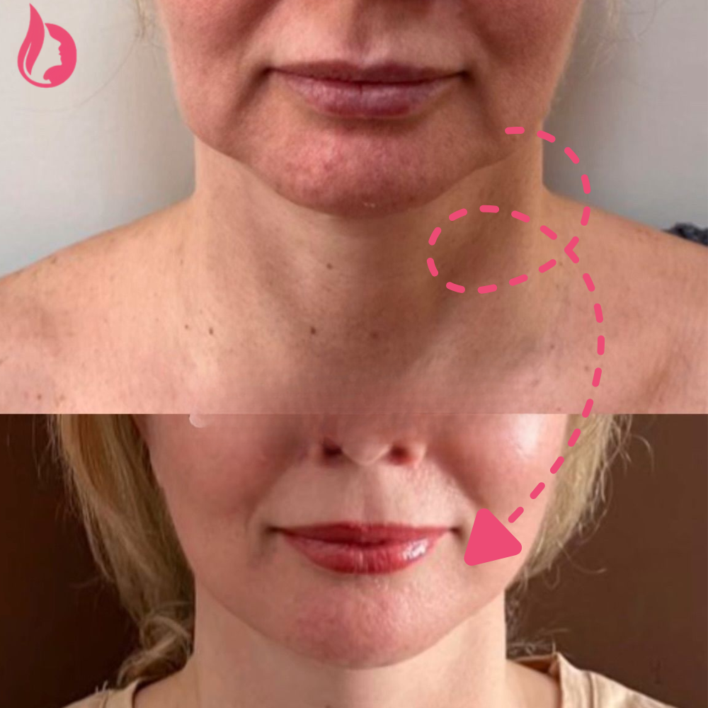 Chin Botox Before And After​