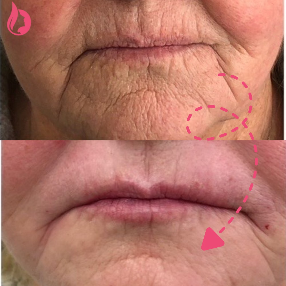 Chin Botox Before And After​