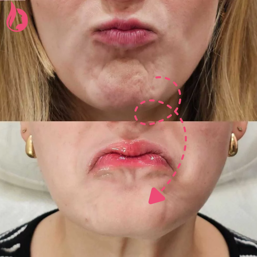 Chin Botox Before And After​