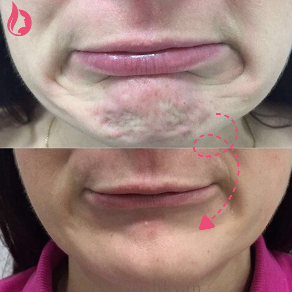 Chin Botox Before And After​