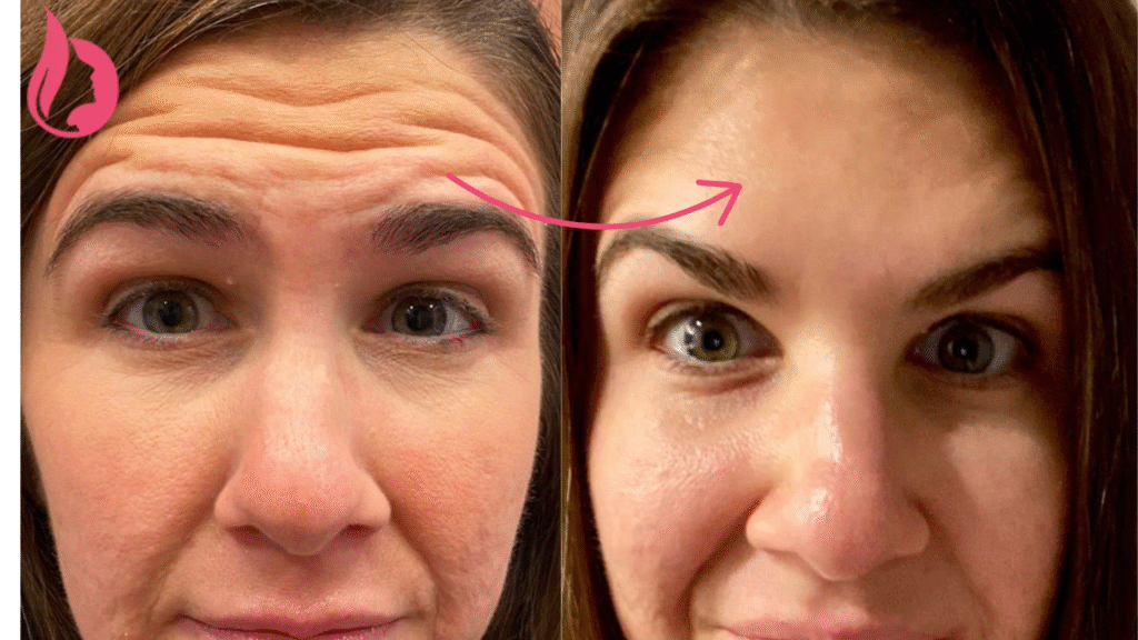 Botox Forehead Before And After