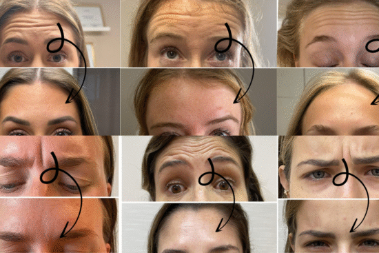Botox forehead before and after