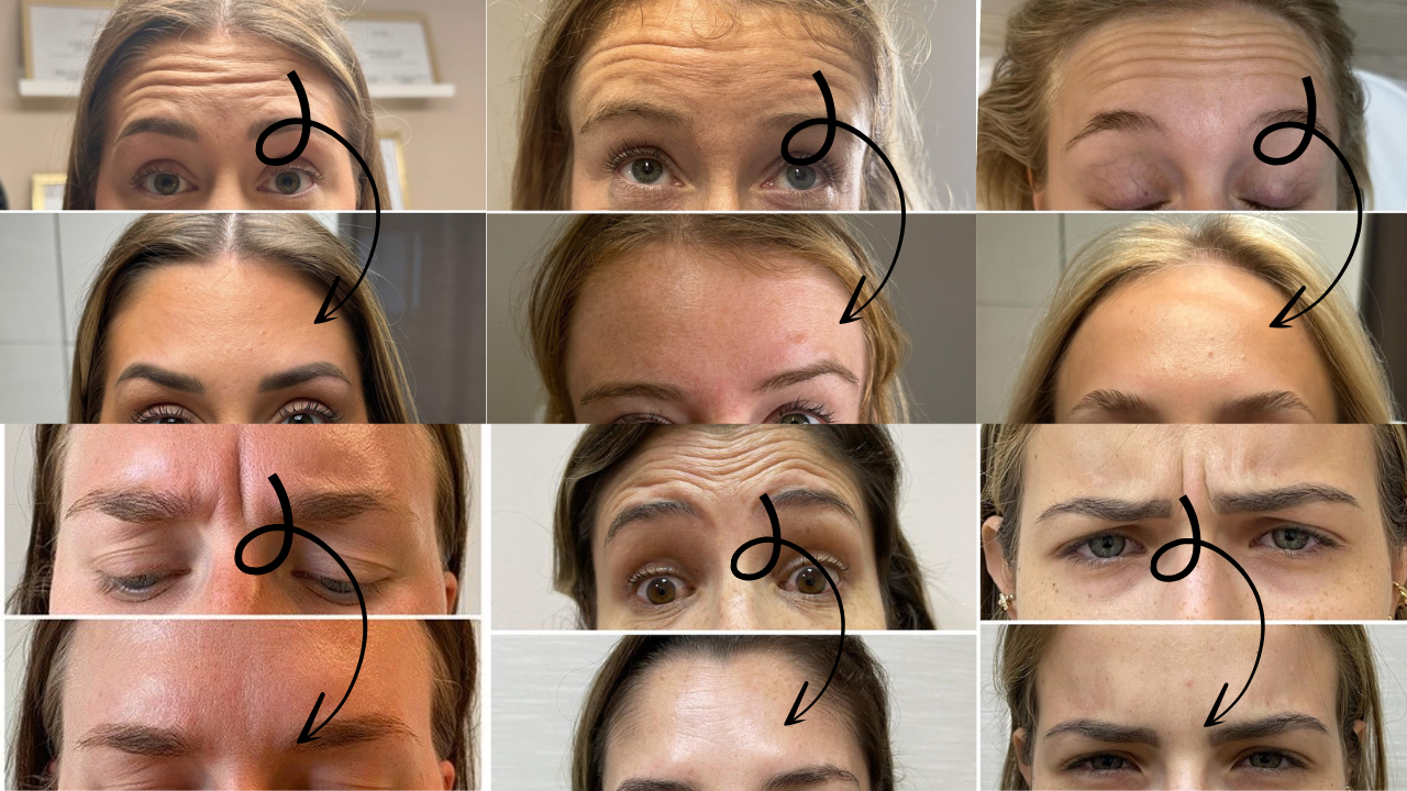 Botox forehead before and after