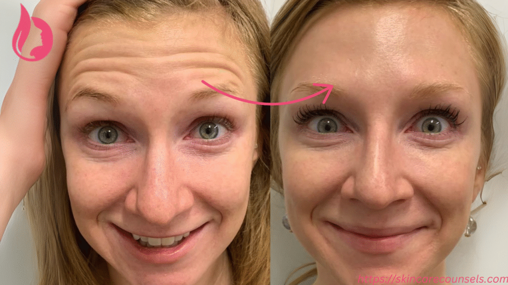 Botox Forehead Before And After