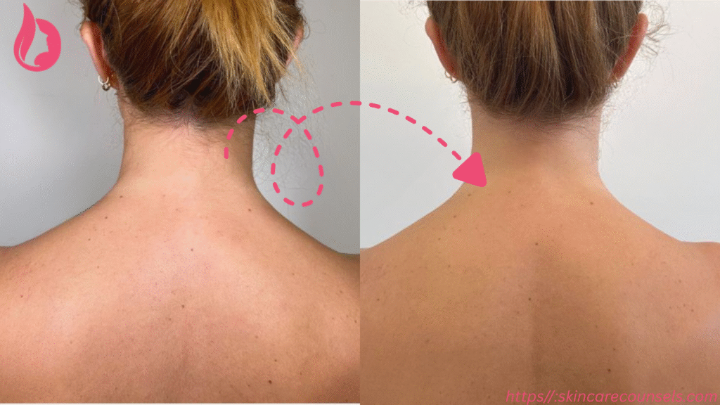 trap botox before and after