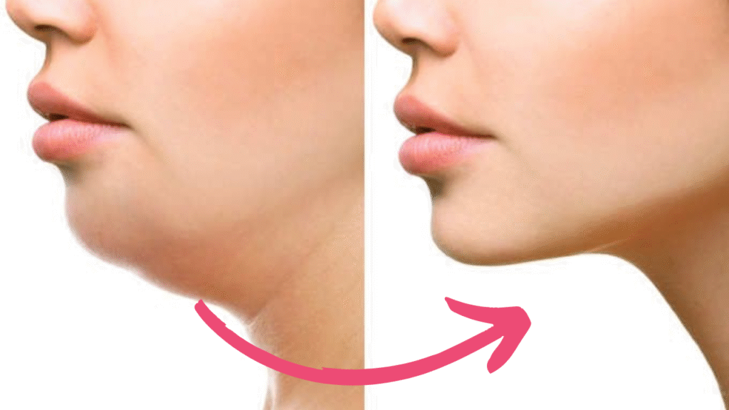 double chin botox before and after​