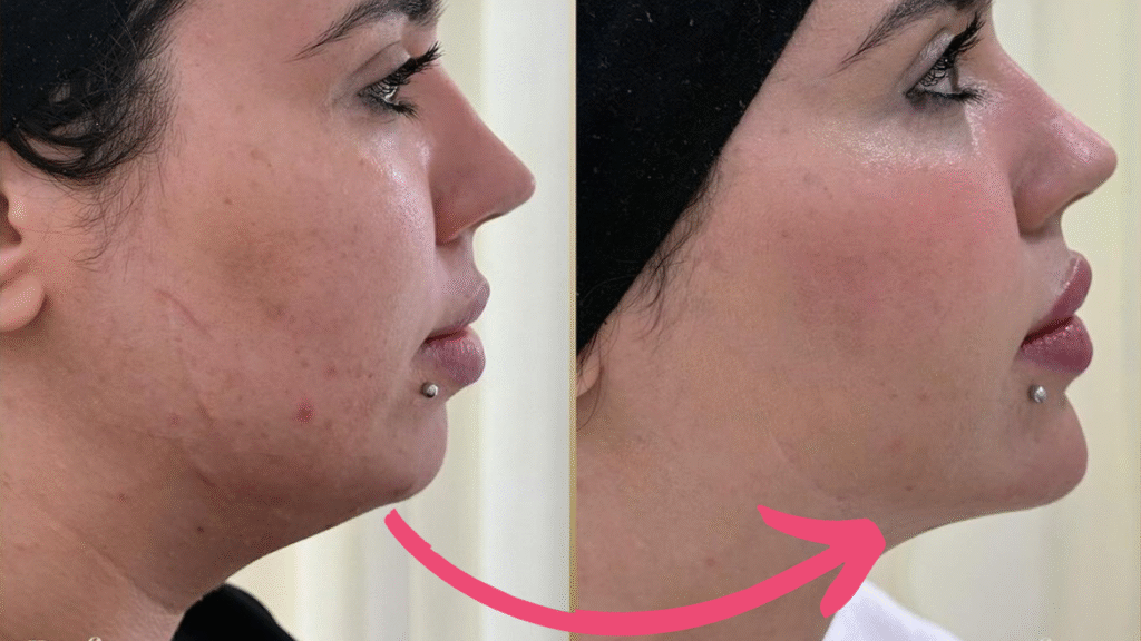 double chin botox before and after​