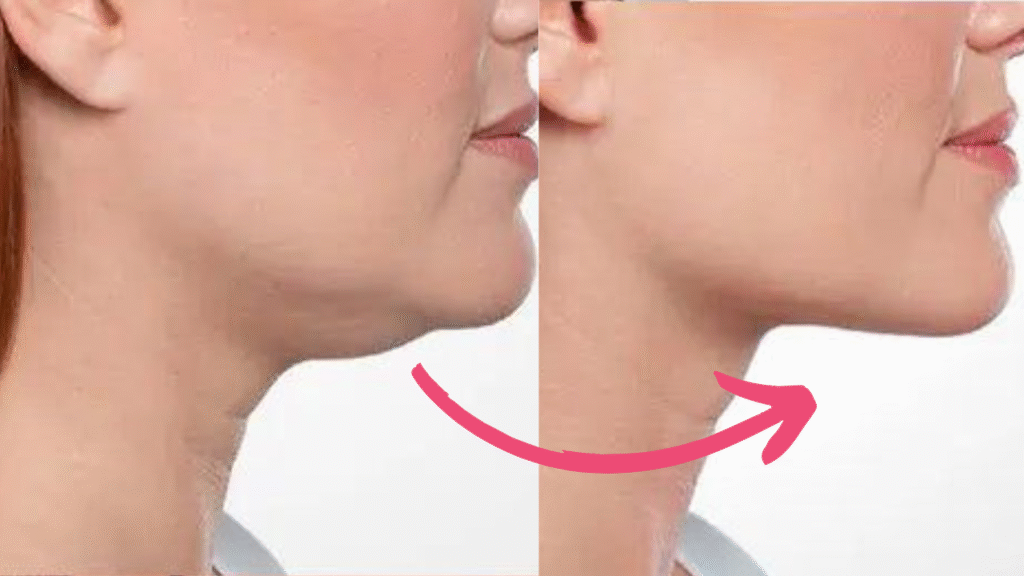double chin botox before and after​