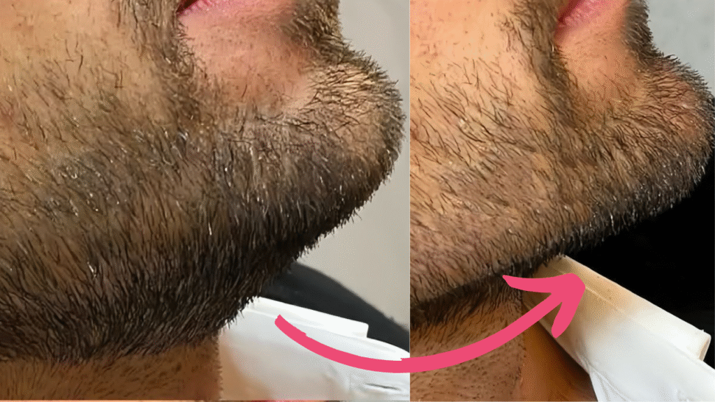 double chin botox before and after​