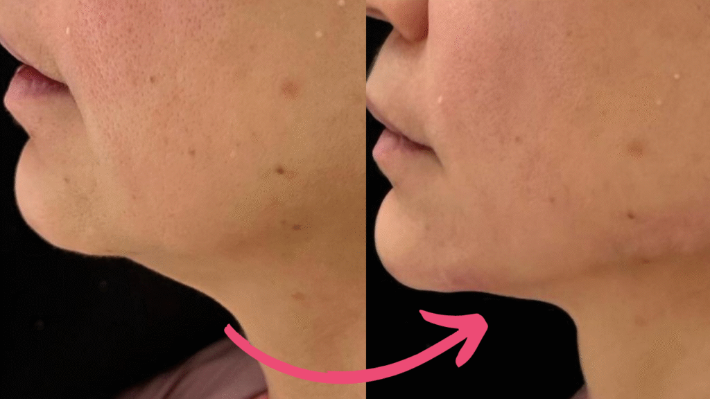 double chin botox before and after​