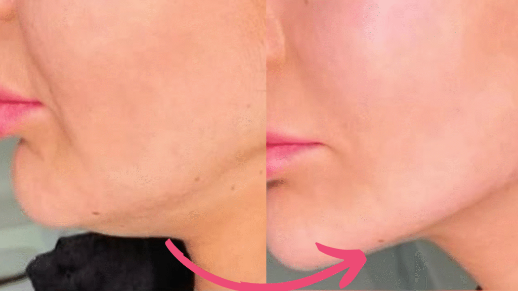 double chin botox before and after​
