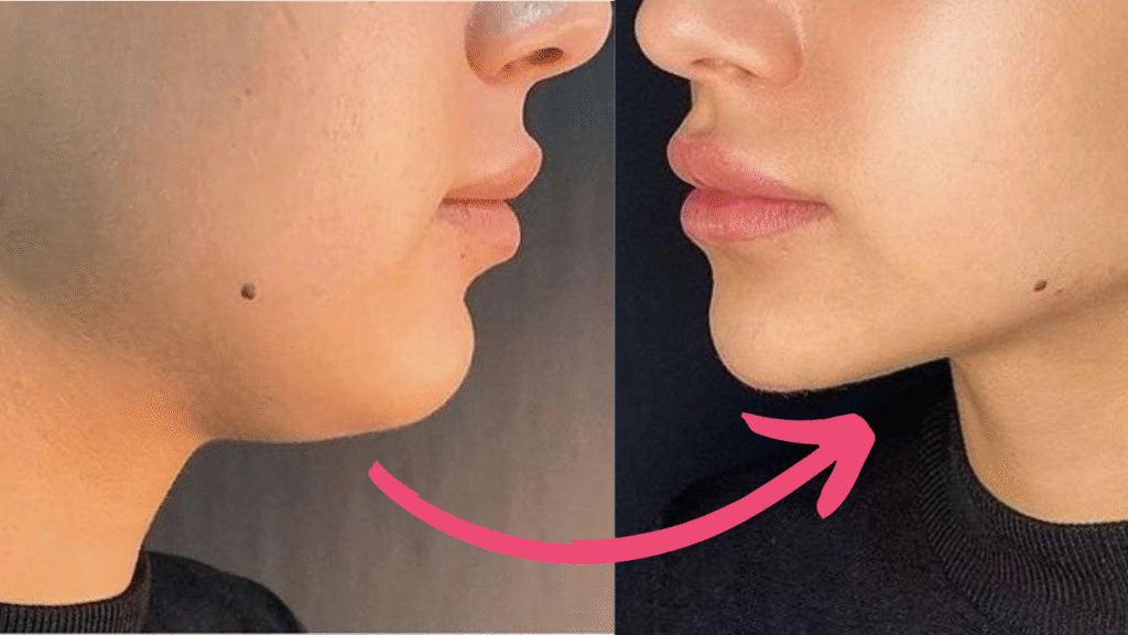 double chin botox before and after​