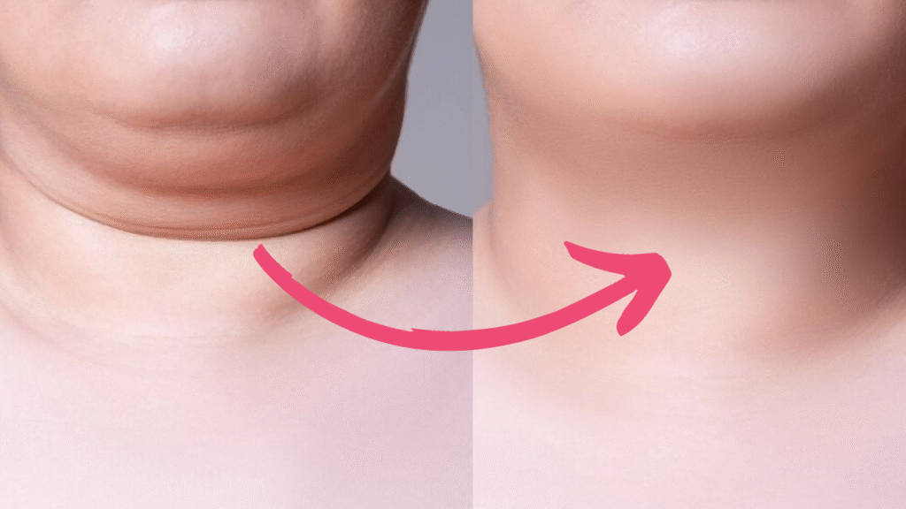 double chin botox before and after​