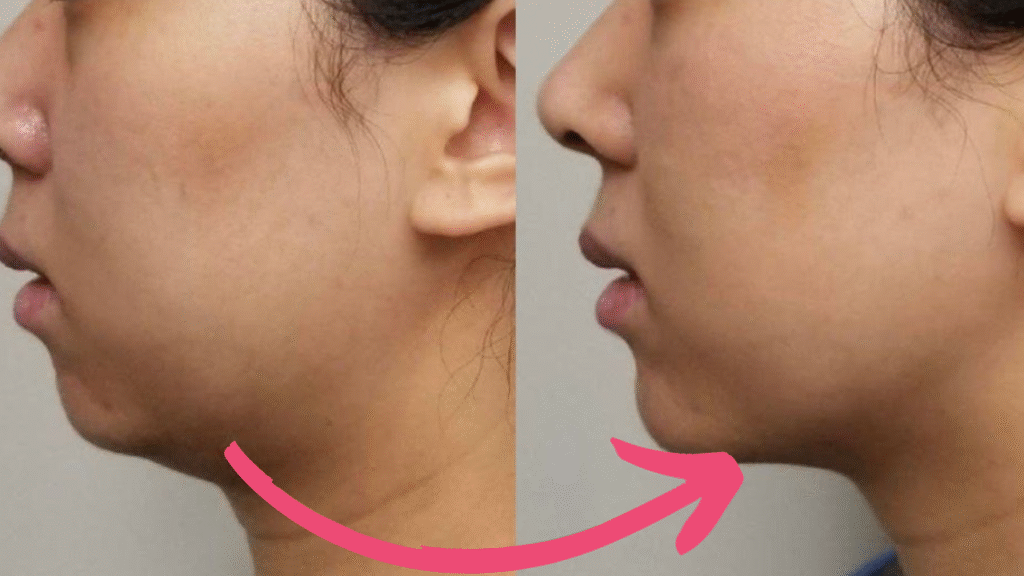 double chin botox before and after​