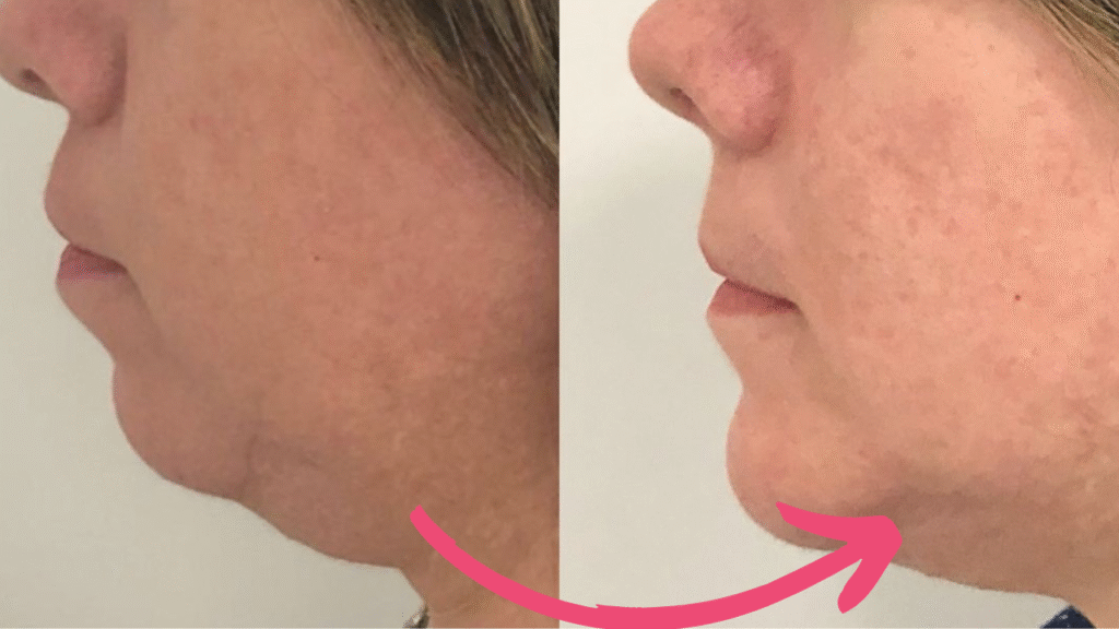 double chin botox before and after​