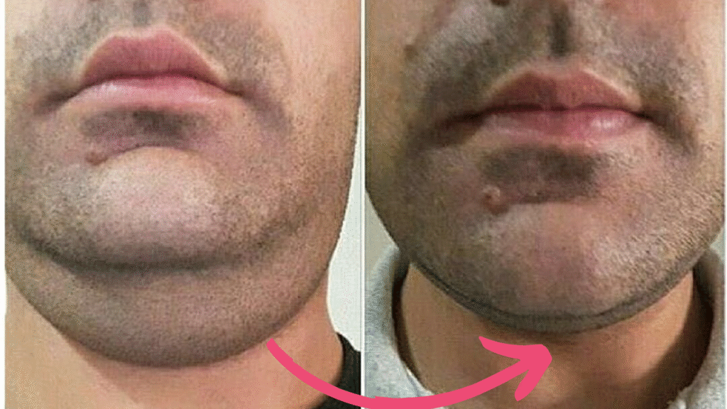 double chin botox before and after​
