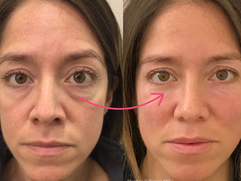 botox under eyes before and after​