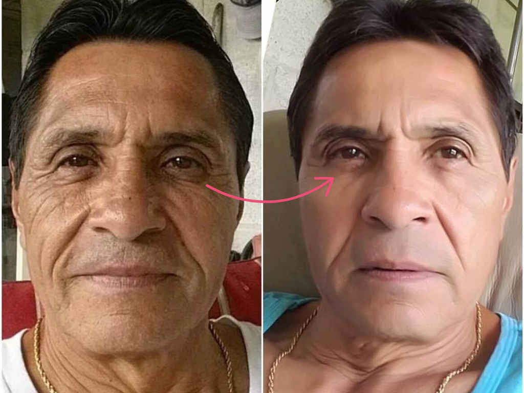 botox under eyes before and after​