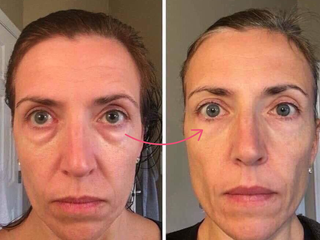 botox under eyes before and after​