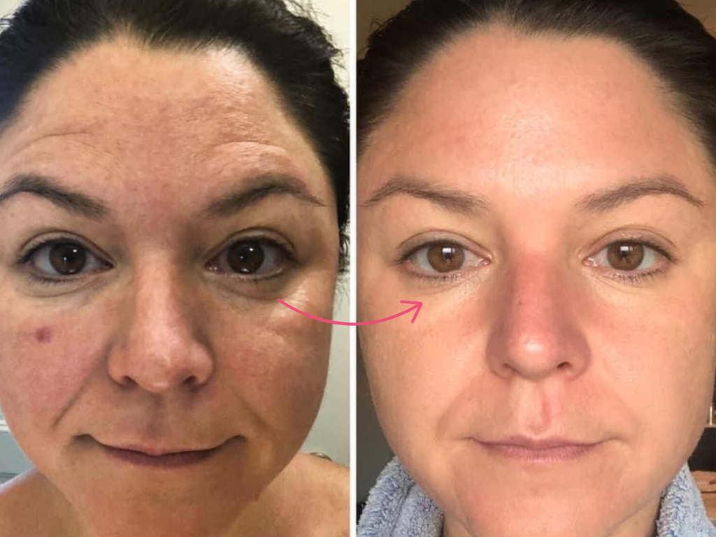 botox under eyes before and after​