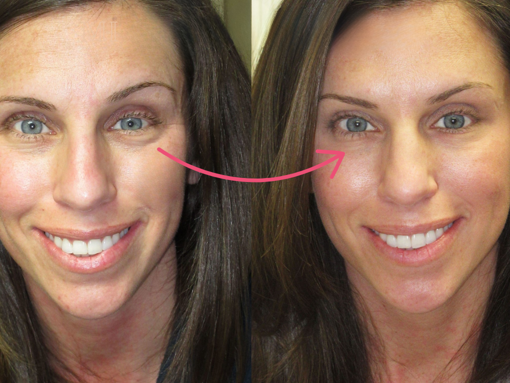 botox under eyes before and after​