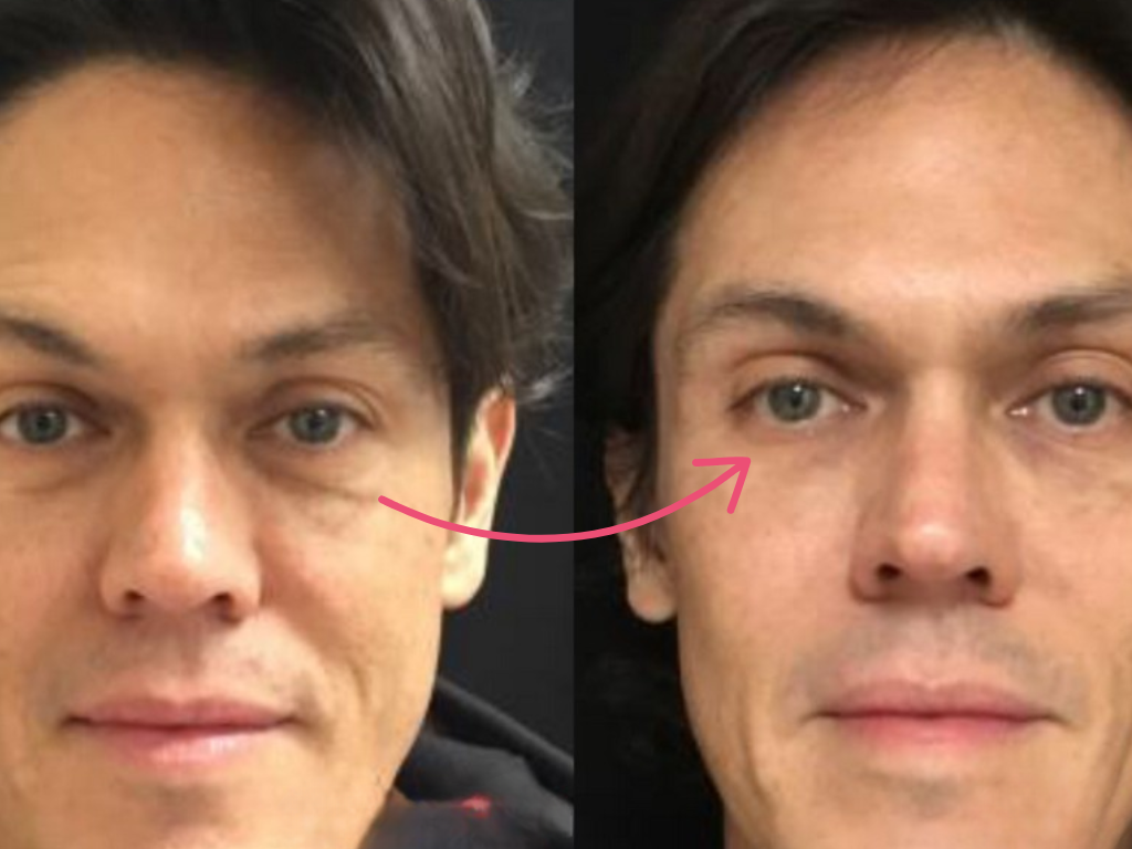 botox under eyes before and after​