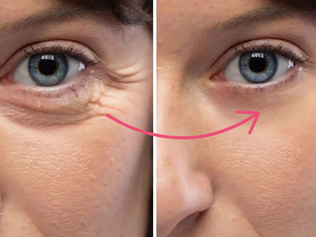 botox under eyes before and after​