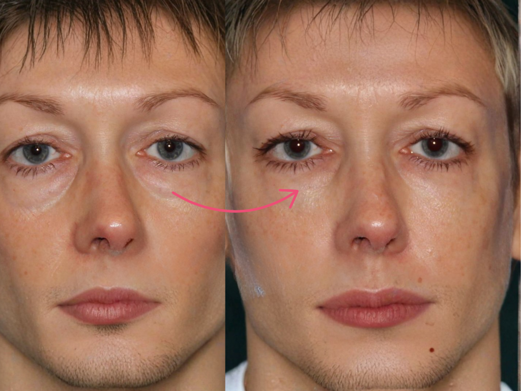 botox under eyes before and after​