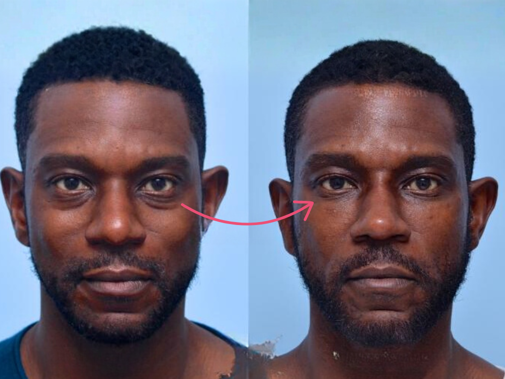 botox under eyes before and after​
