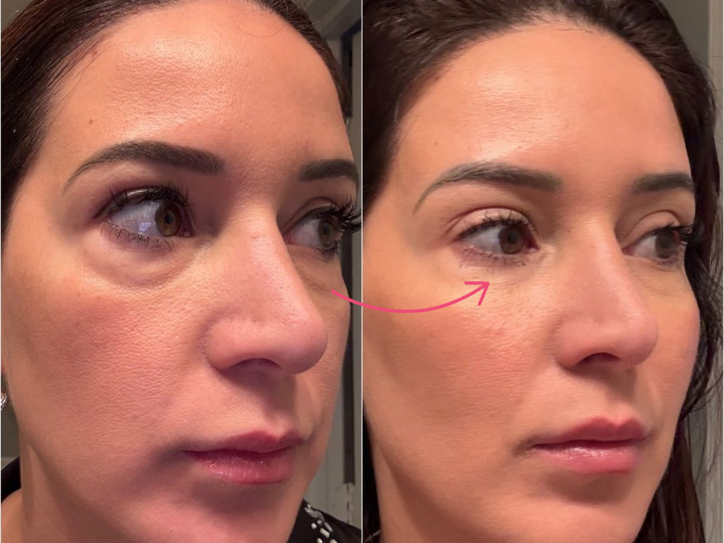 botox under eyes before and after​