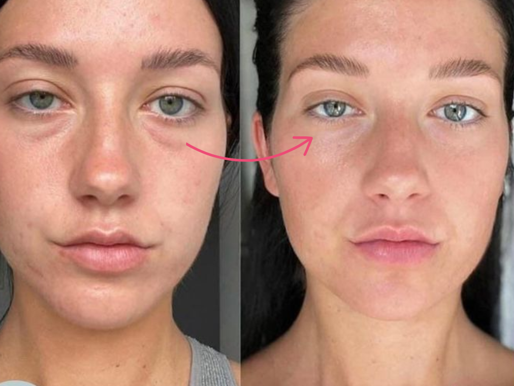 botox under eyes before and after​