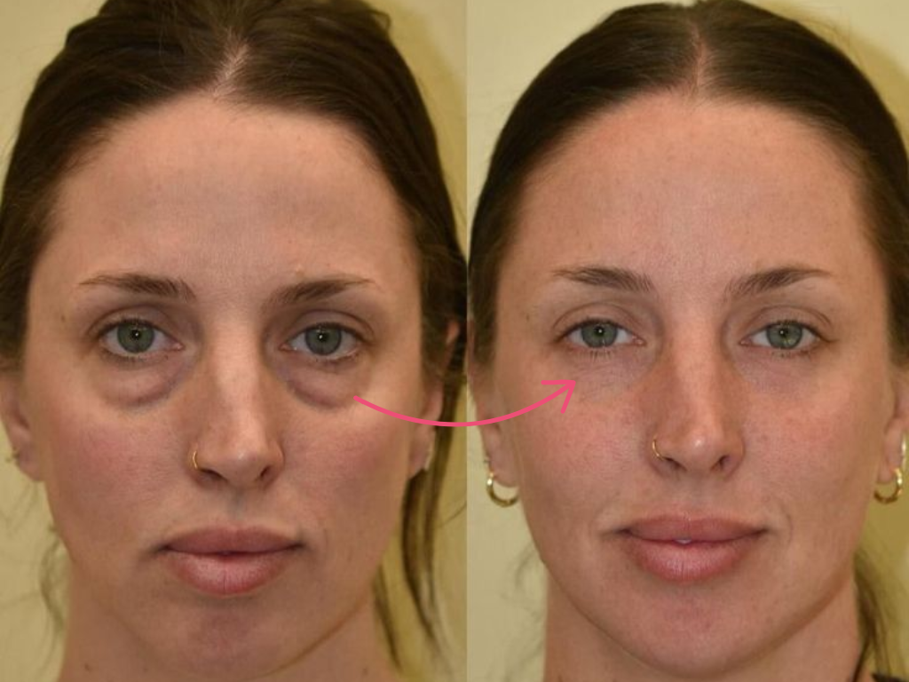 botox under eyes before and after​