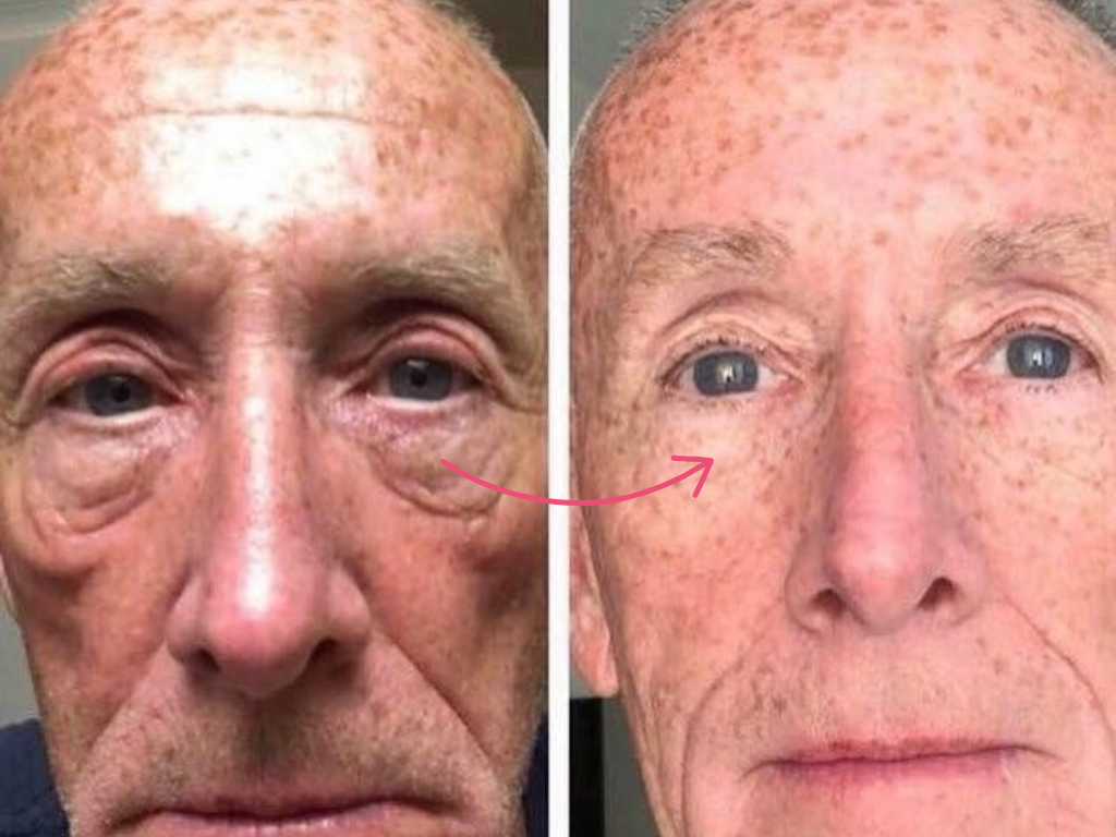 botox under eyes before and after​